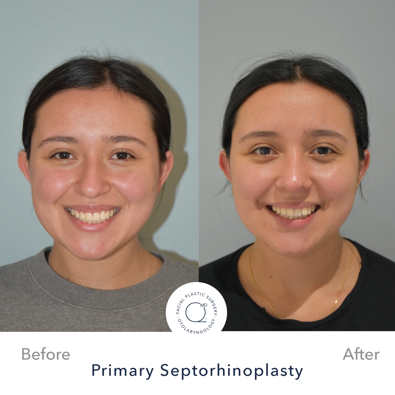 Rinoplastia Madrid caso 33 fotografía 5