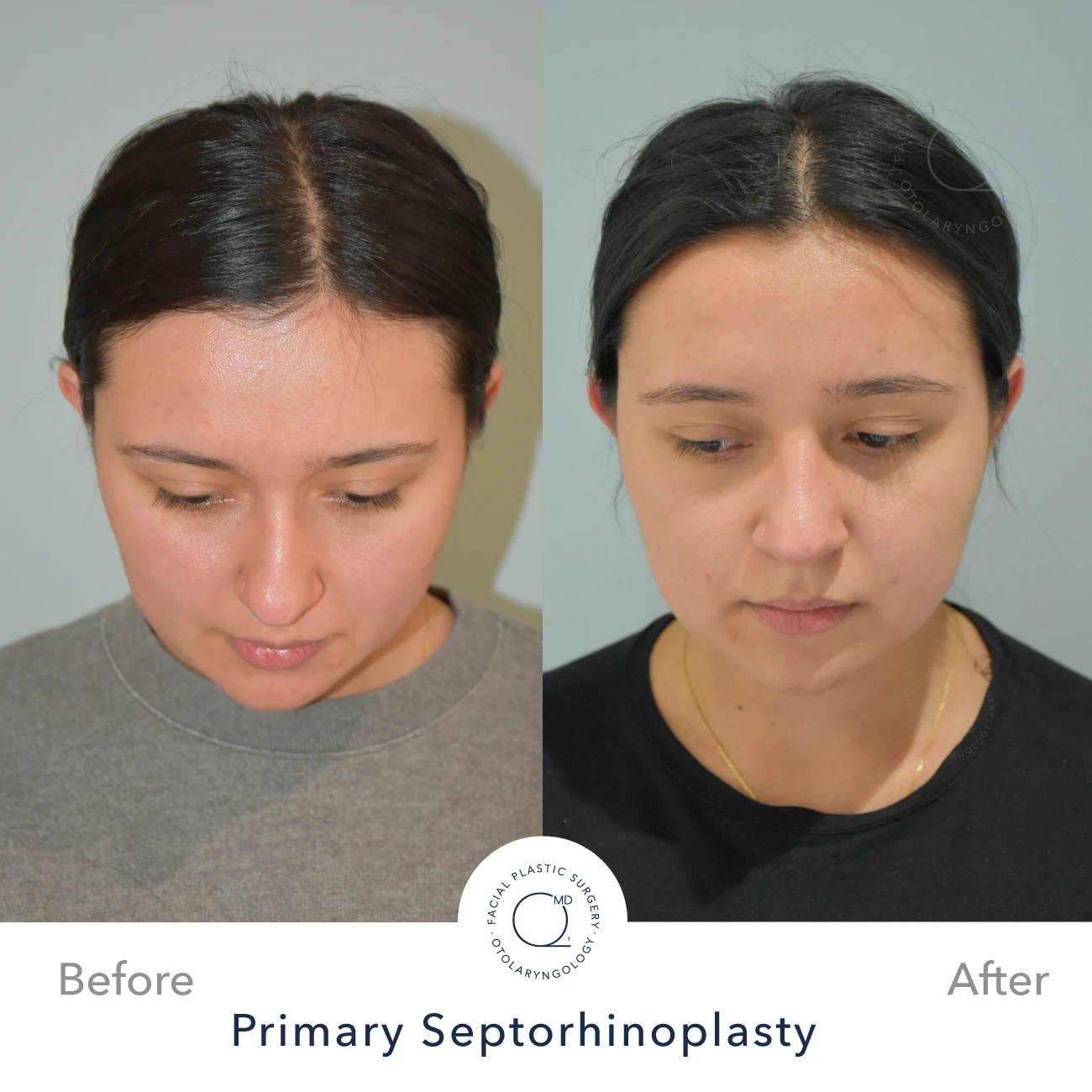 Rinoplastia Madrid caso 33 fotografía 6