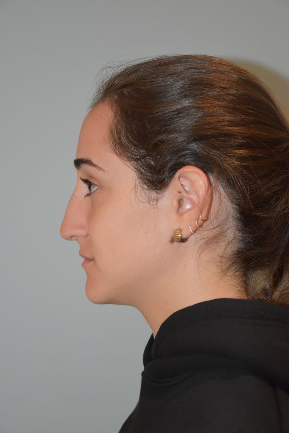 Rinoplastia Madrid caso 34 fotografía 1