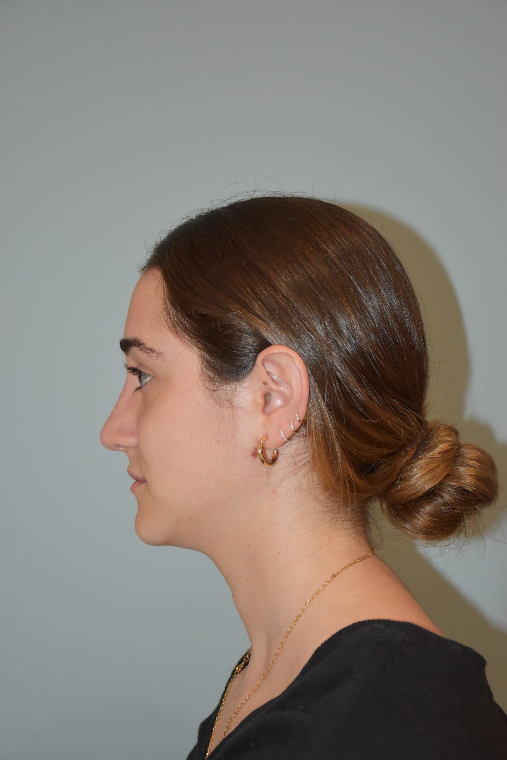 Rinoplastia Madrid caso 34 fotografía 2
