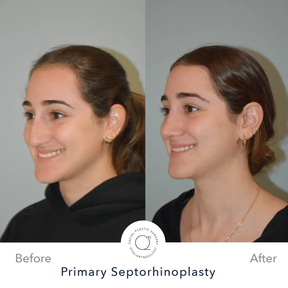 Rinoplastia Madrid caso 34 fotografía 3