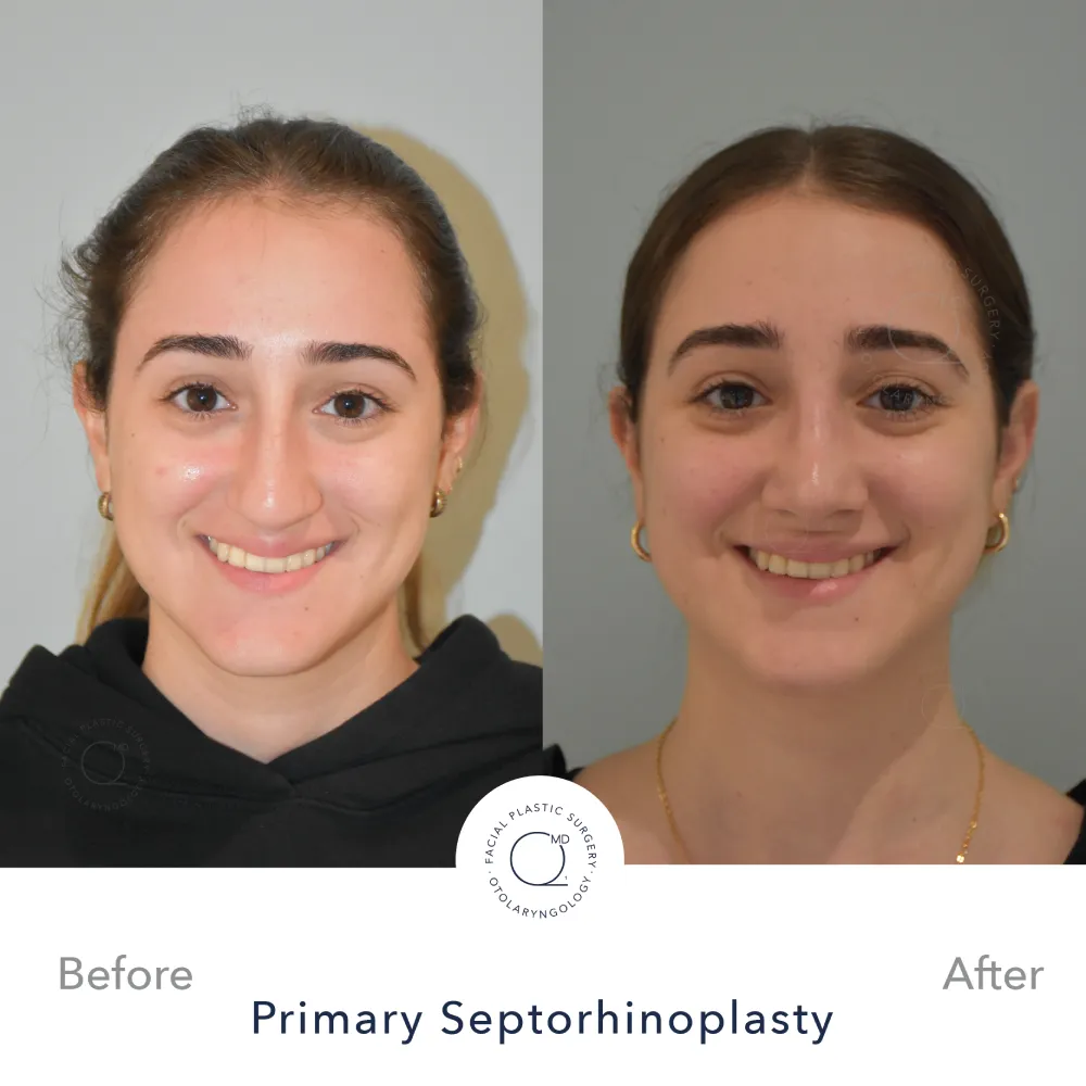 Rinoplastia Madrid caso 34 fotografía 4