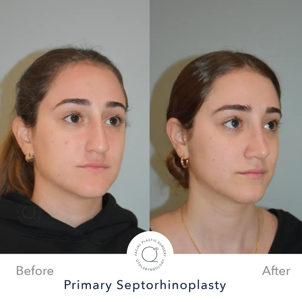 Rinoplastia Madrid caso 34 fotografía 5