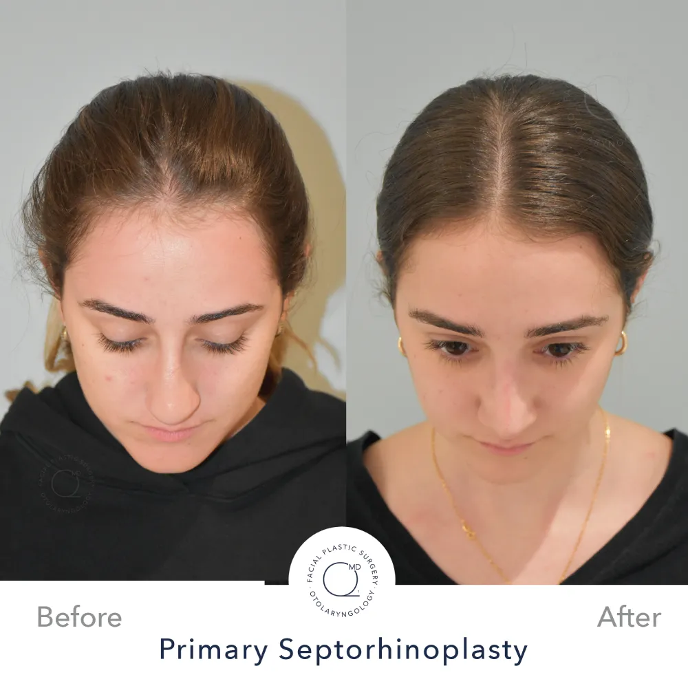 Rinoplastia Madrid caso 34 fotografía 6