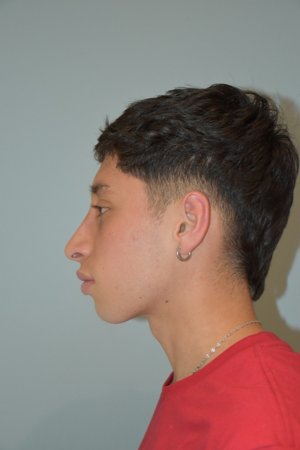 Rinoplastia Madrid caso 35 fotografía 2