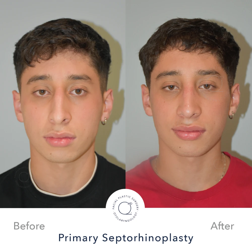 Rinoplastia Madrid caso 35 fotografía 3