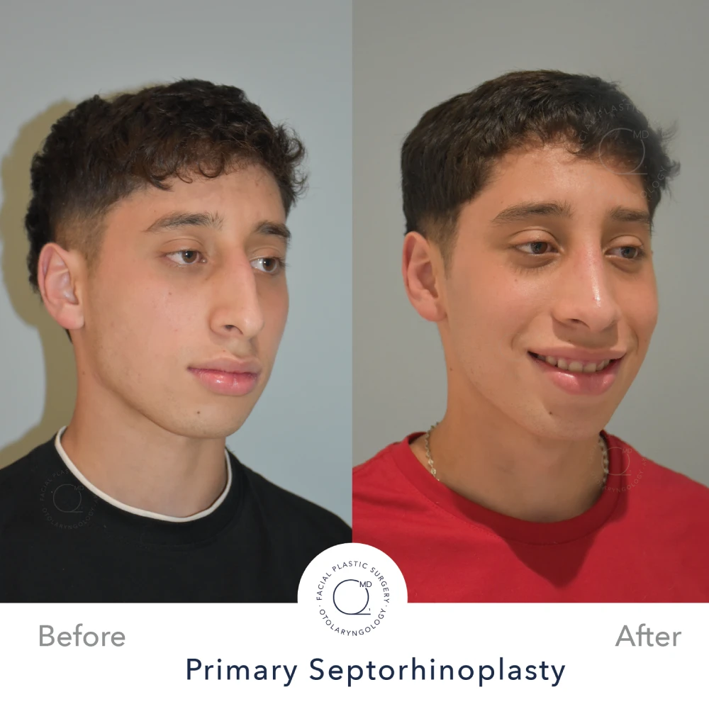 Rinoplastia Madrid caso 35 fotografía 4