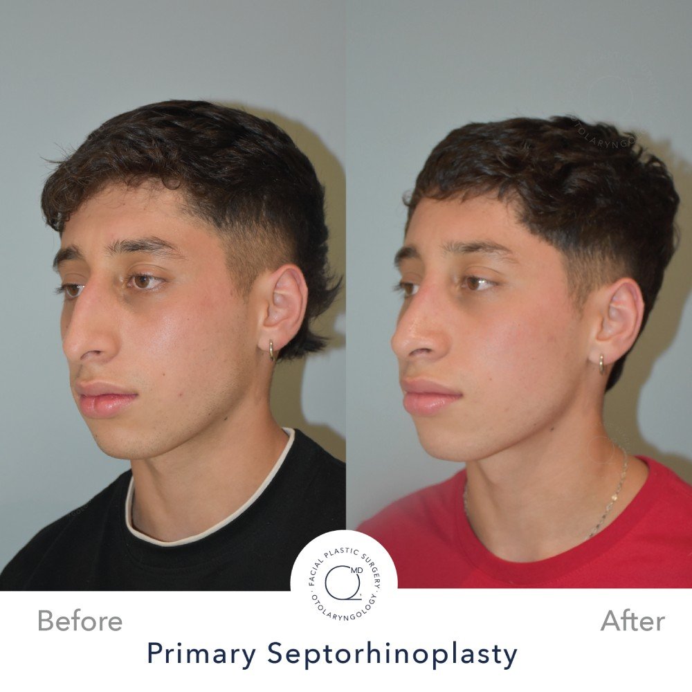 Rinoplastia Madrid caso 35 fotografía 5