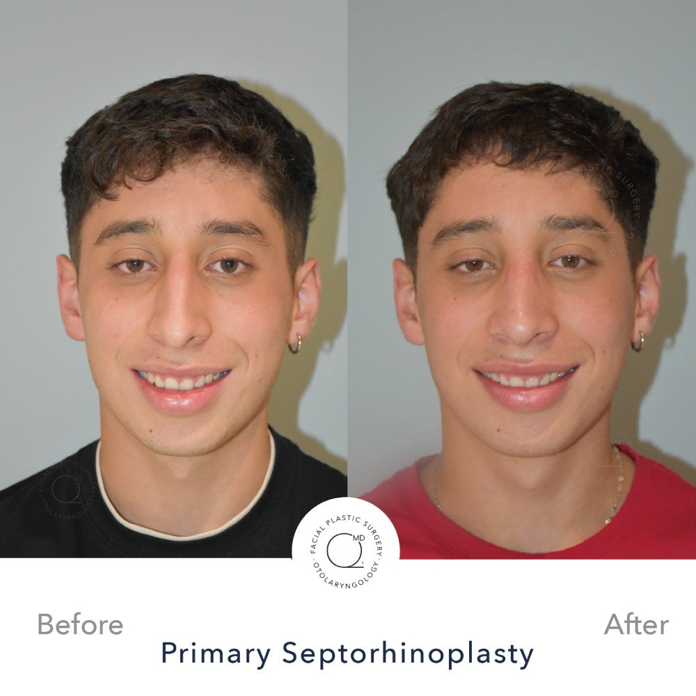 Rinoplastia Madrid caso 35 fotografía 6
