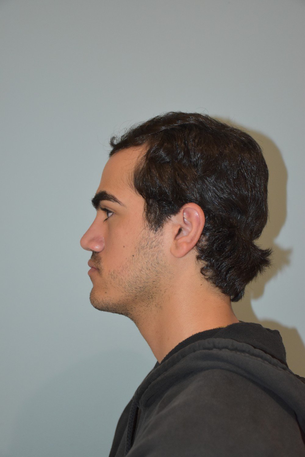 Rinoplastia Madrid caso 36 fotografía 2