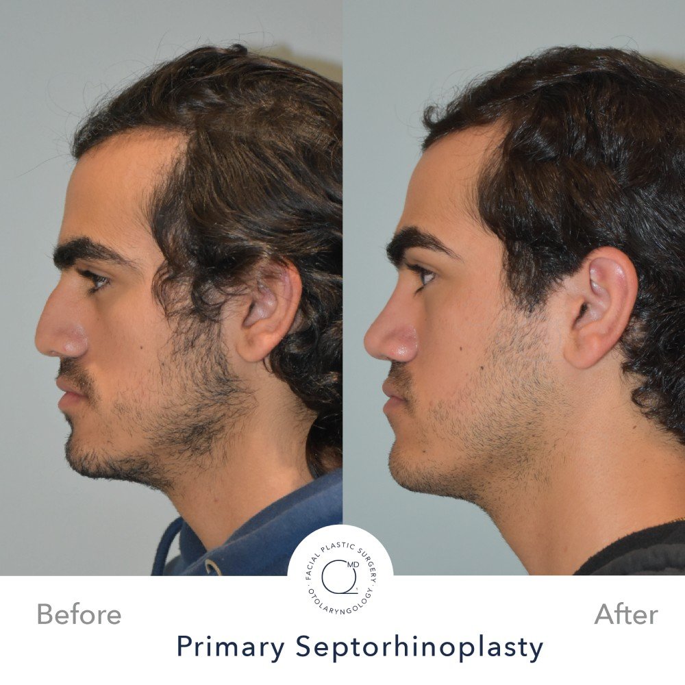 Rinoplastia Madrid caso 36 fotografía 3