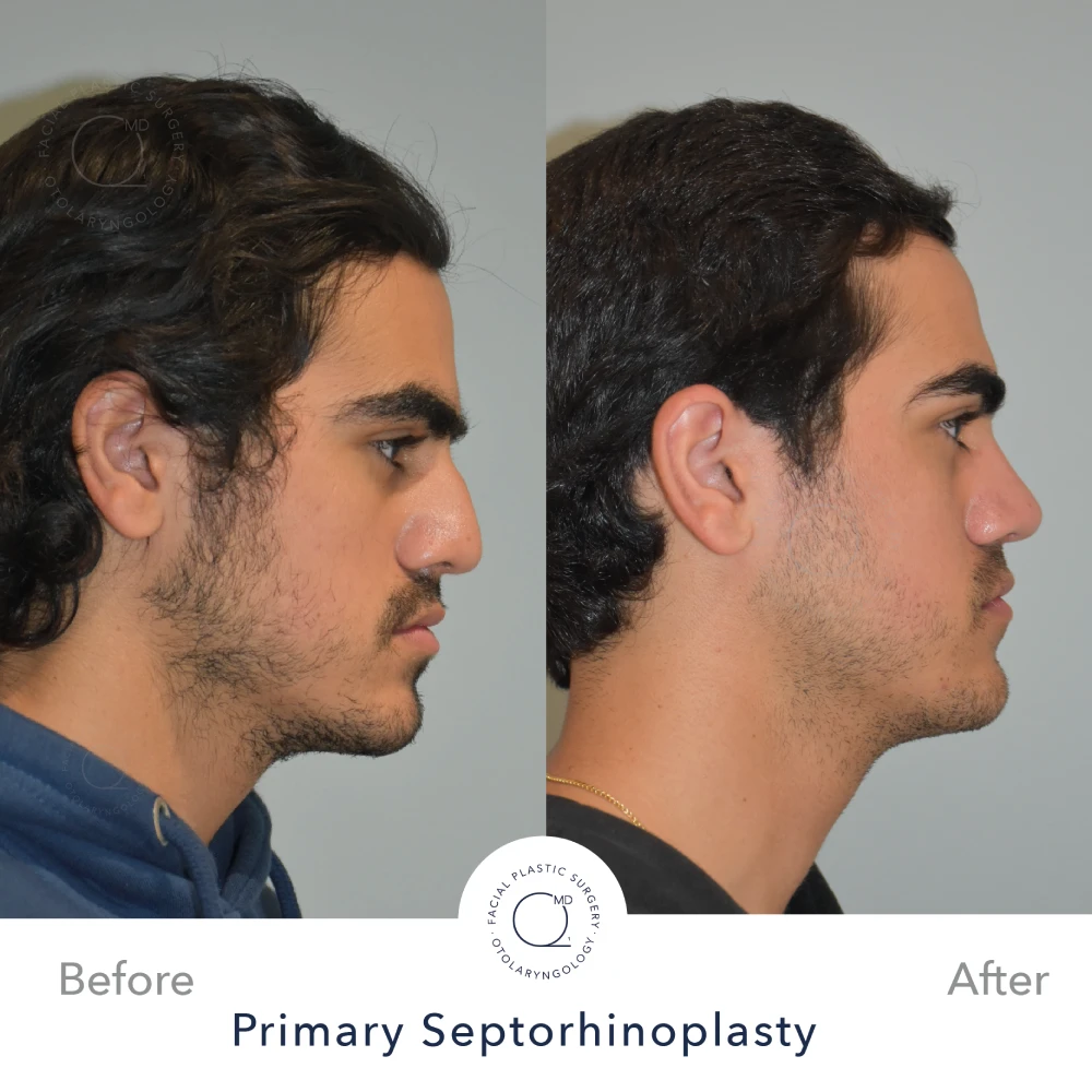 Rinoplastia Madrid caso 36 fotografía 4