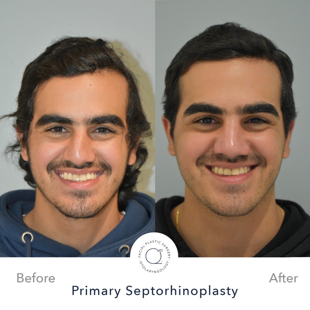 Rinoplastia Madrid caso 36 fotografía 5
