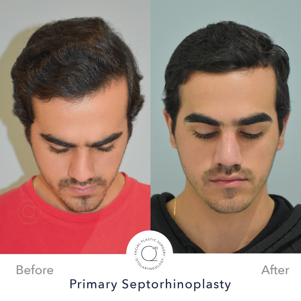 Rinoplastia Madrid caso 36 fotografía 6