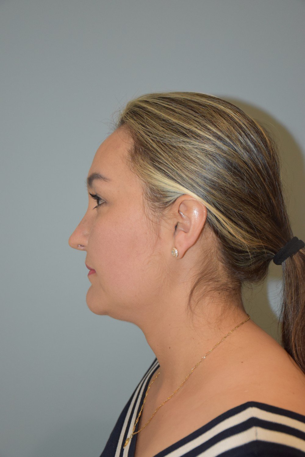 Rinoplastia Madrid caso 37 fotografía 2