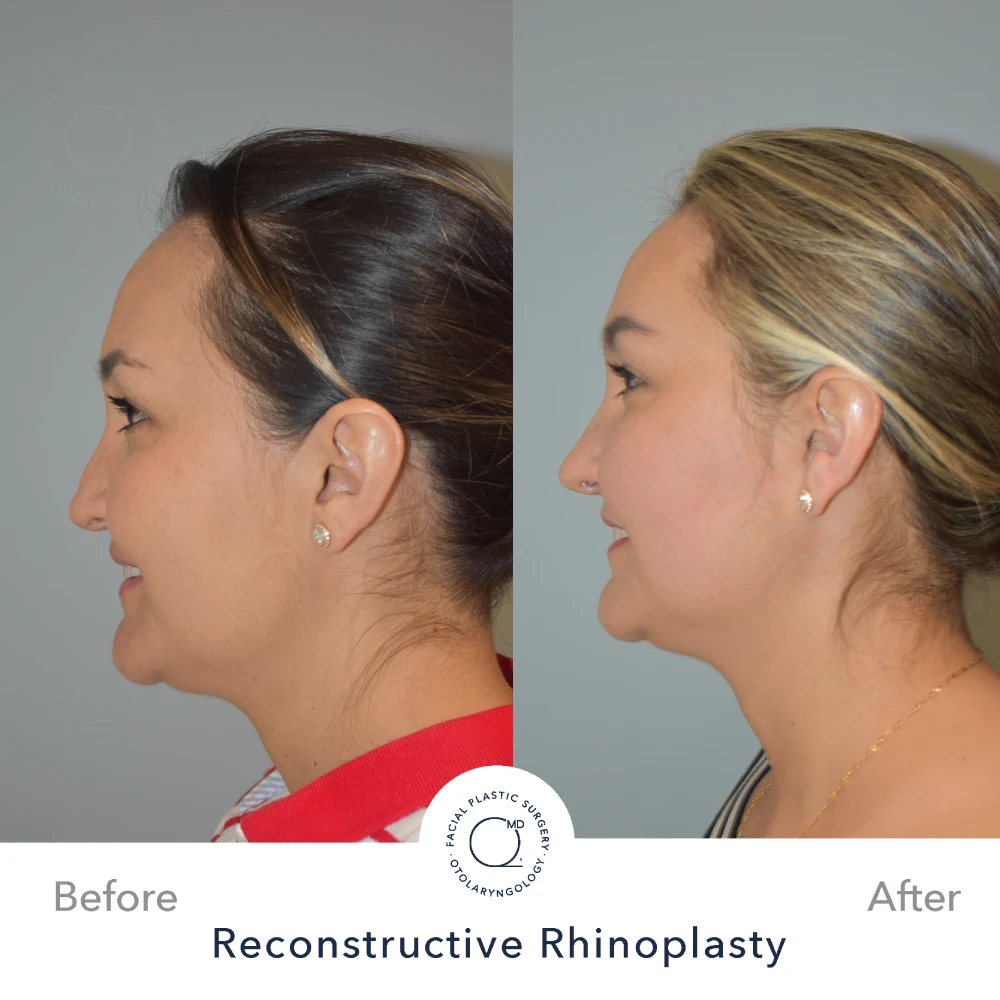 Rinoplastia Madrid caso 37 fotografía 3