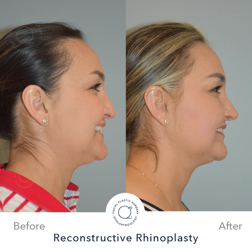 Rinoplastia Madrid caso 37 fotografía 4