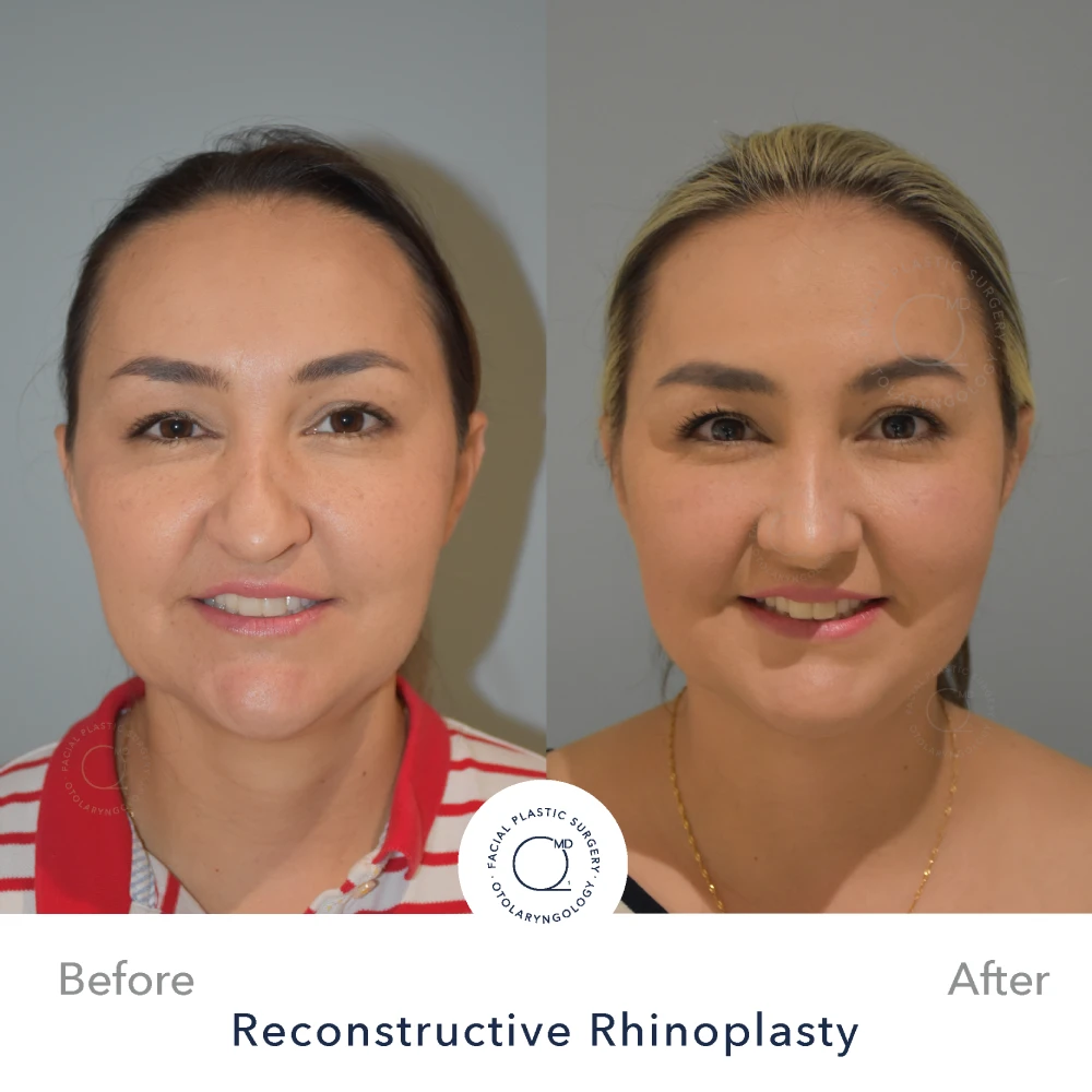 Rinoplastia Madrid caso 37 fotografía 5