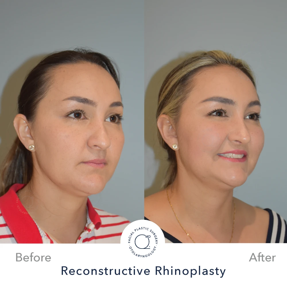 Rinoplastia Madrid caso 37 fotografía 6