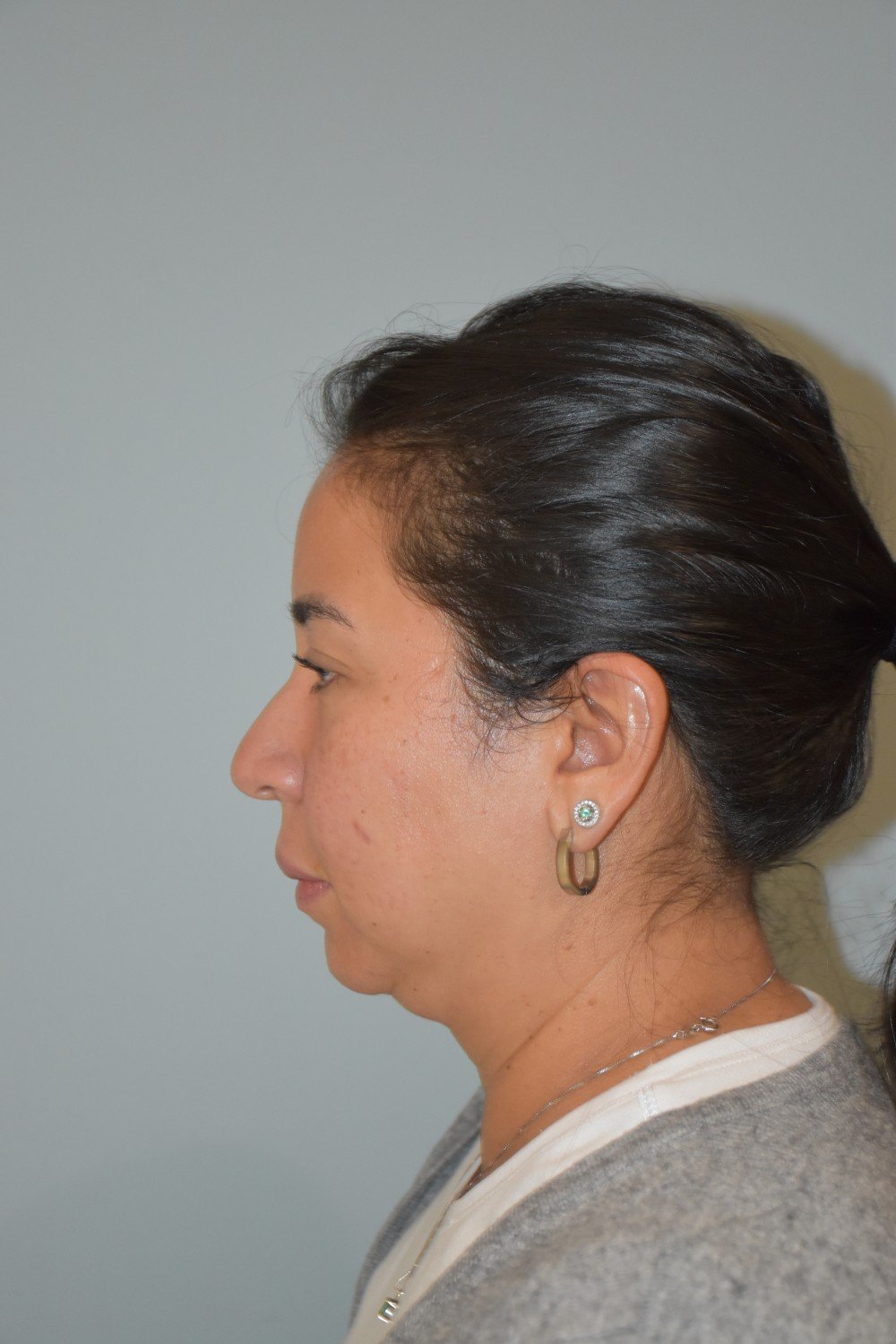 Rinoplastia Madrid caso 38 fotografía 1