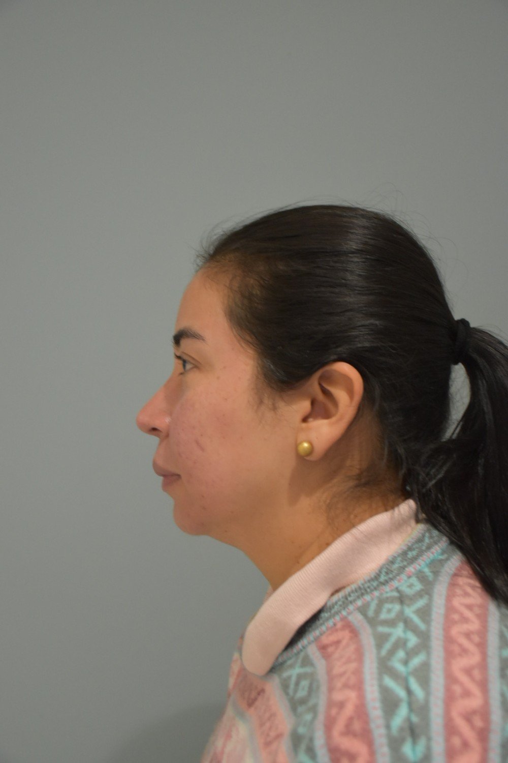Rinoplastia Madrid caso 38 fotografía 2
