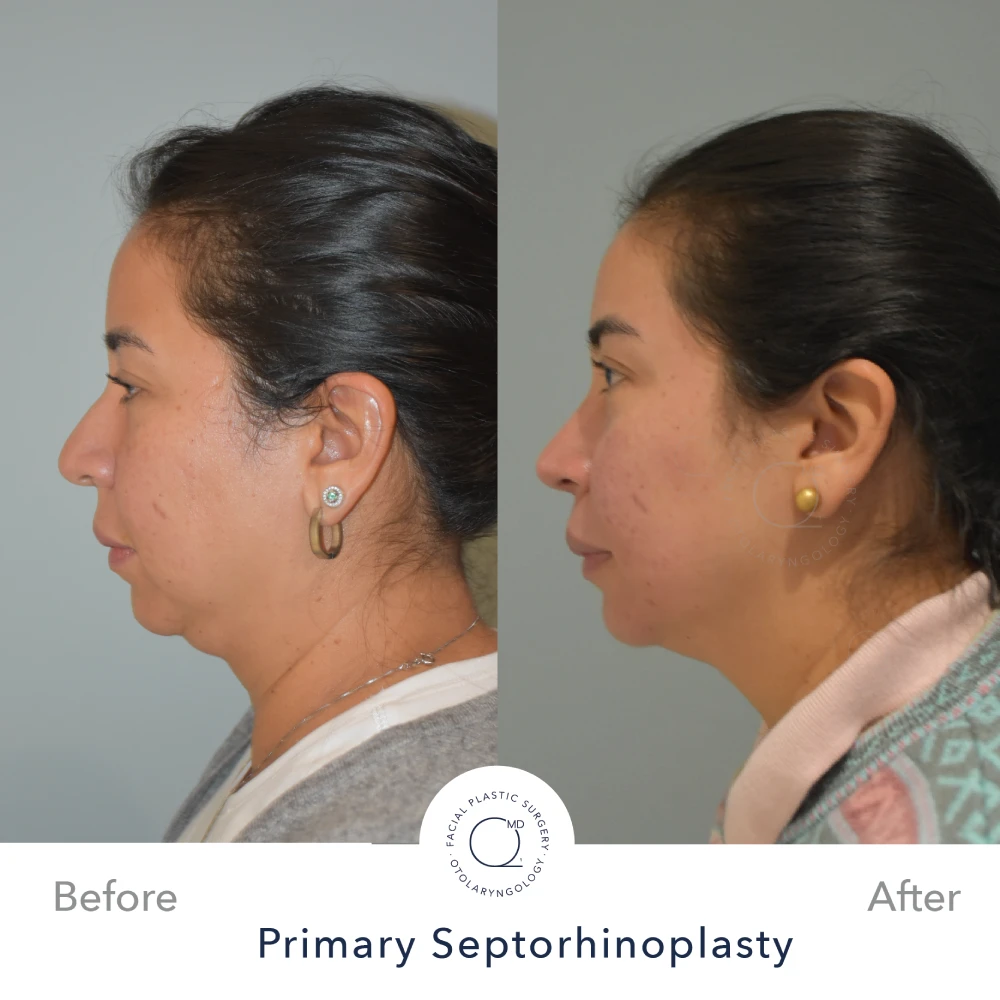 Rinoplastia Madrid caso 38 fotografía 3
