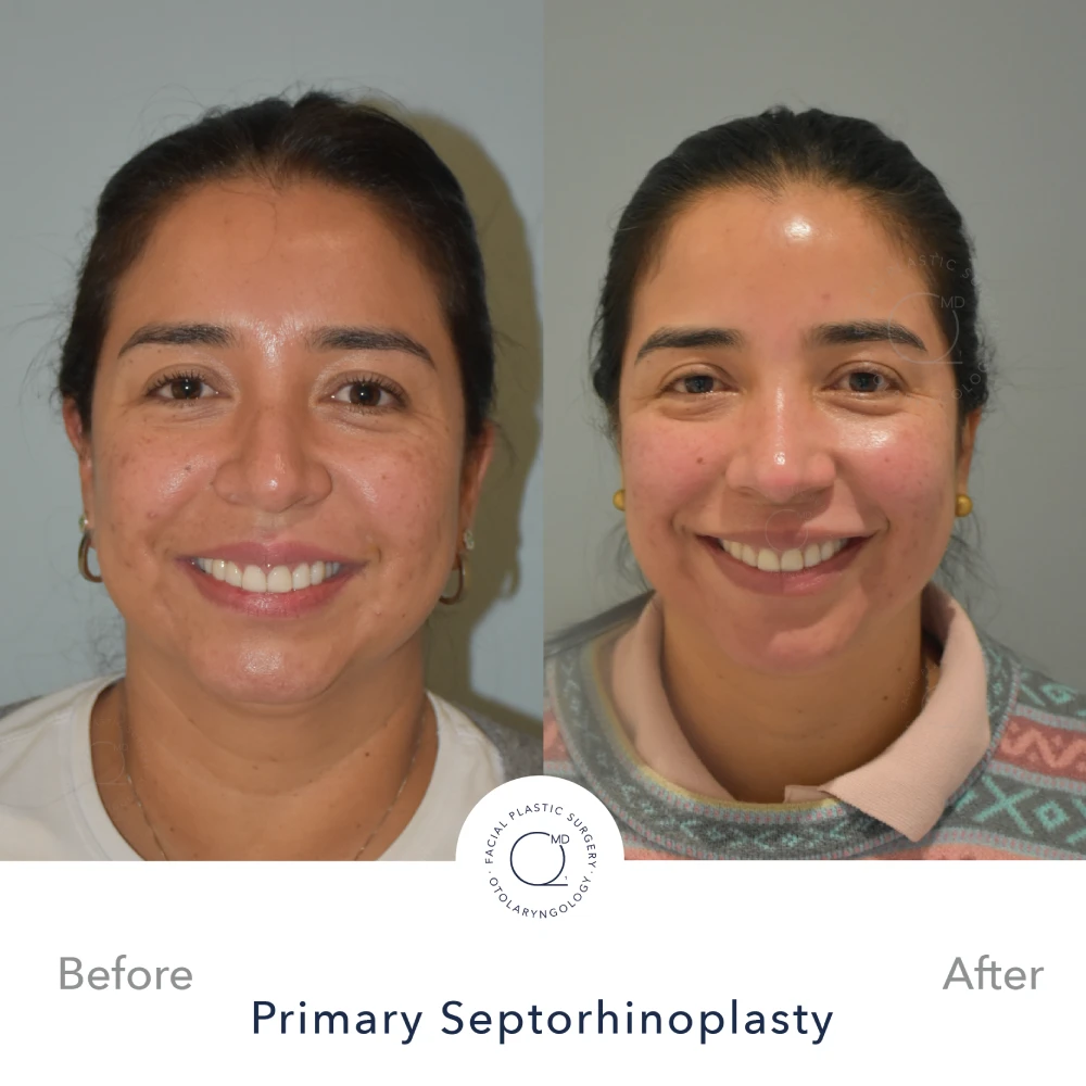 Rinoplastia Madrid caso 38 fotografía 4