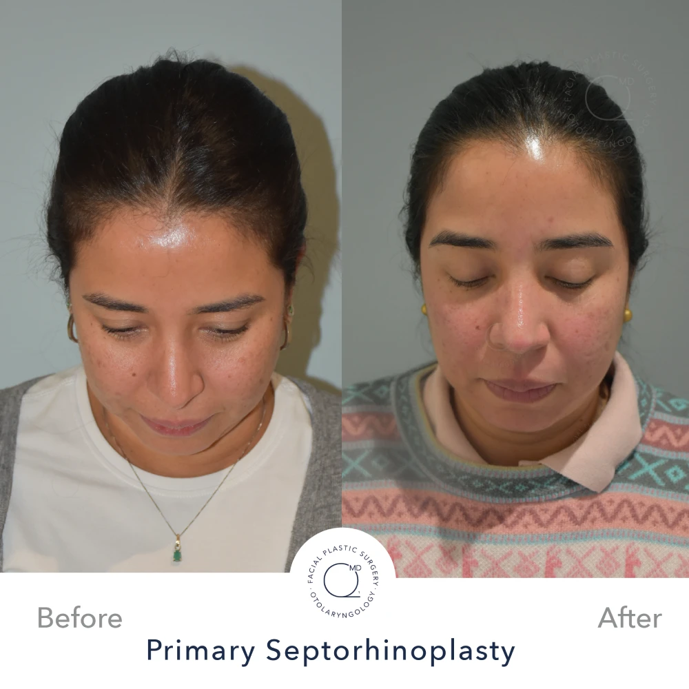 Rinoplastia Madrid caso 38 fotografía 5