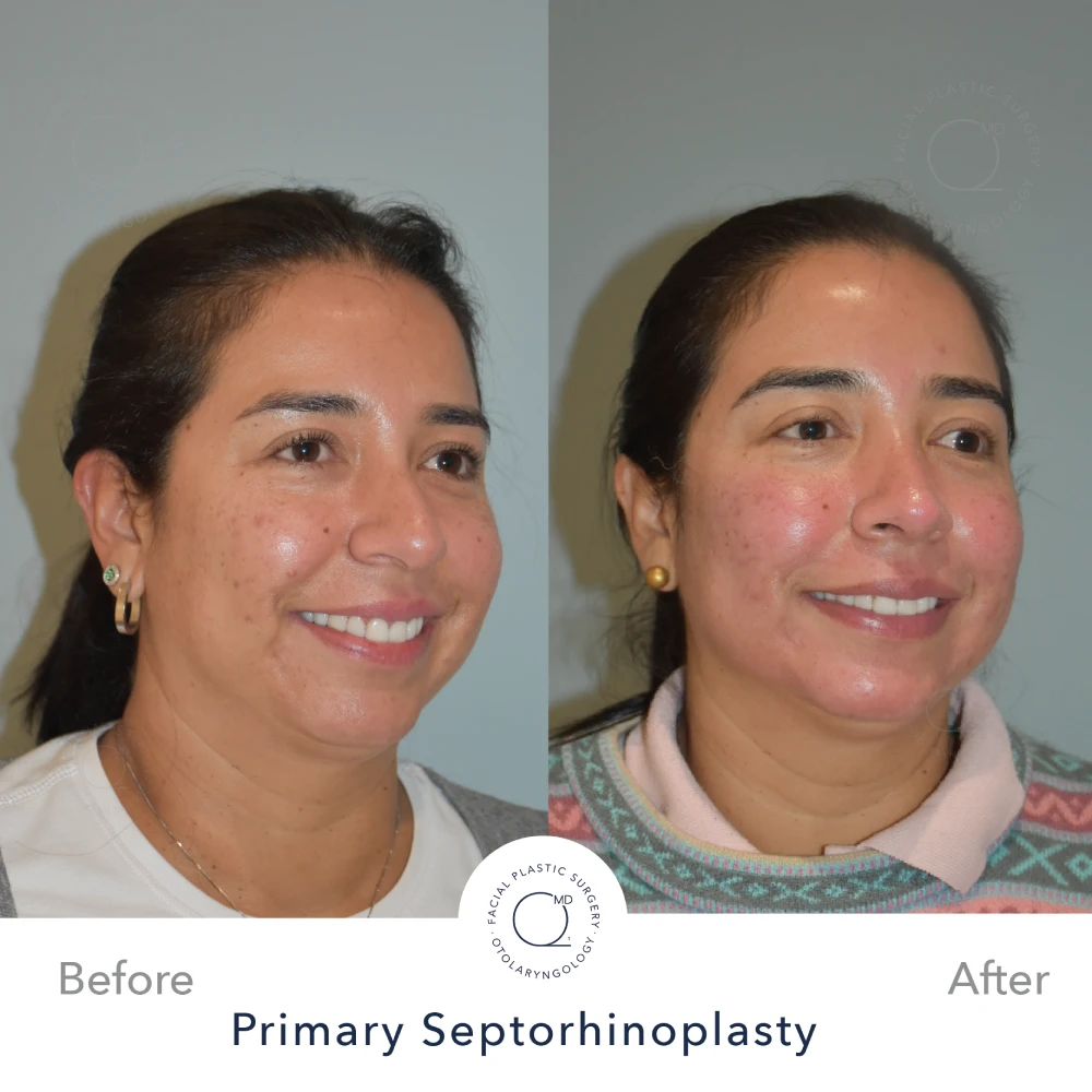 Rinoplastia Madrid caso 38 fotografía 6