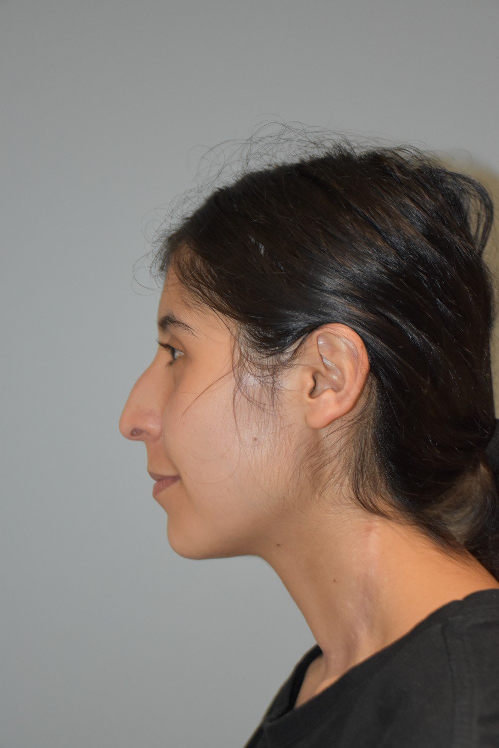 Rinoplastia Madrid caso 39 fotografía 1