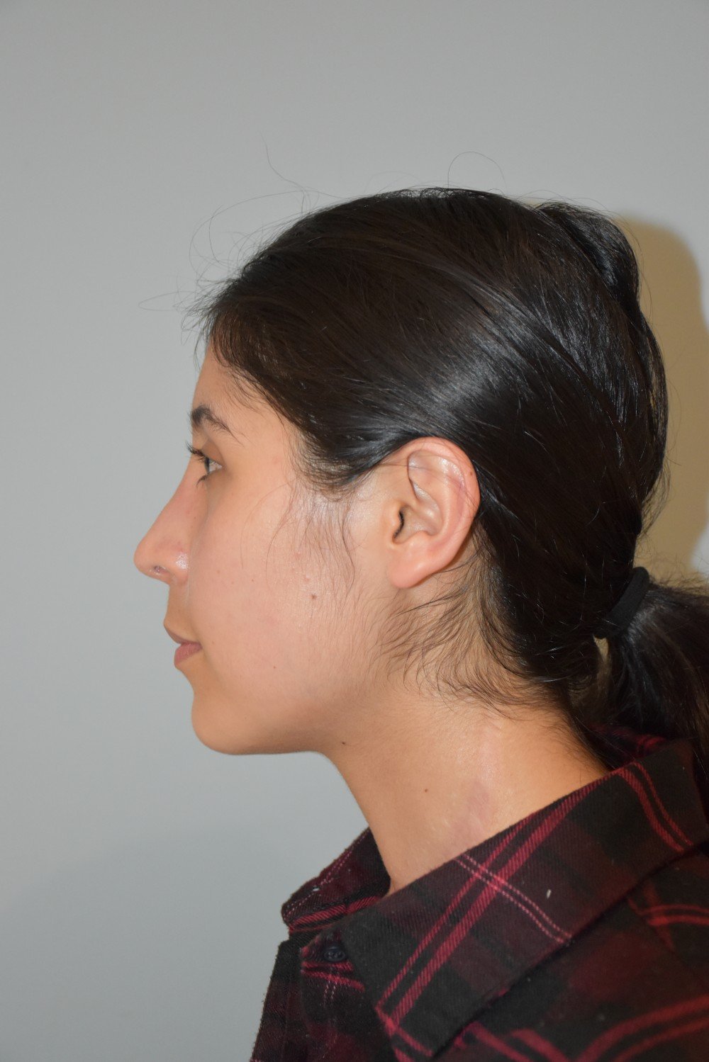Rinoplastia Madrid caso 39 fotografía 2