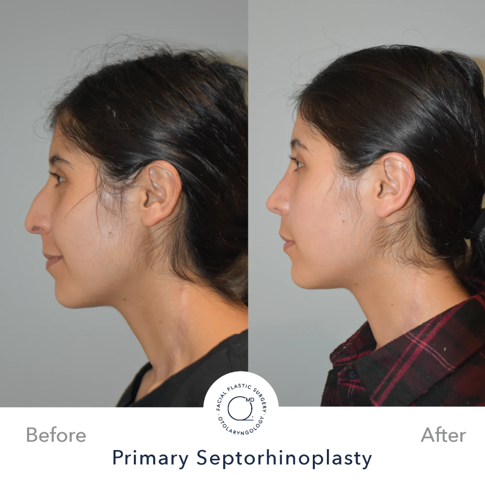 Rinoplastia Madrid caso 39 fotografía 3