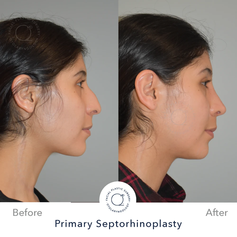 Rinoplastia Madrid caso 39 fotografía 4