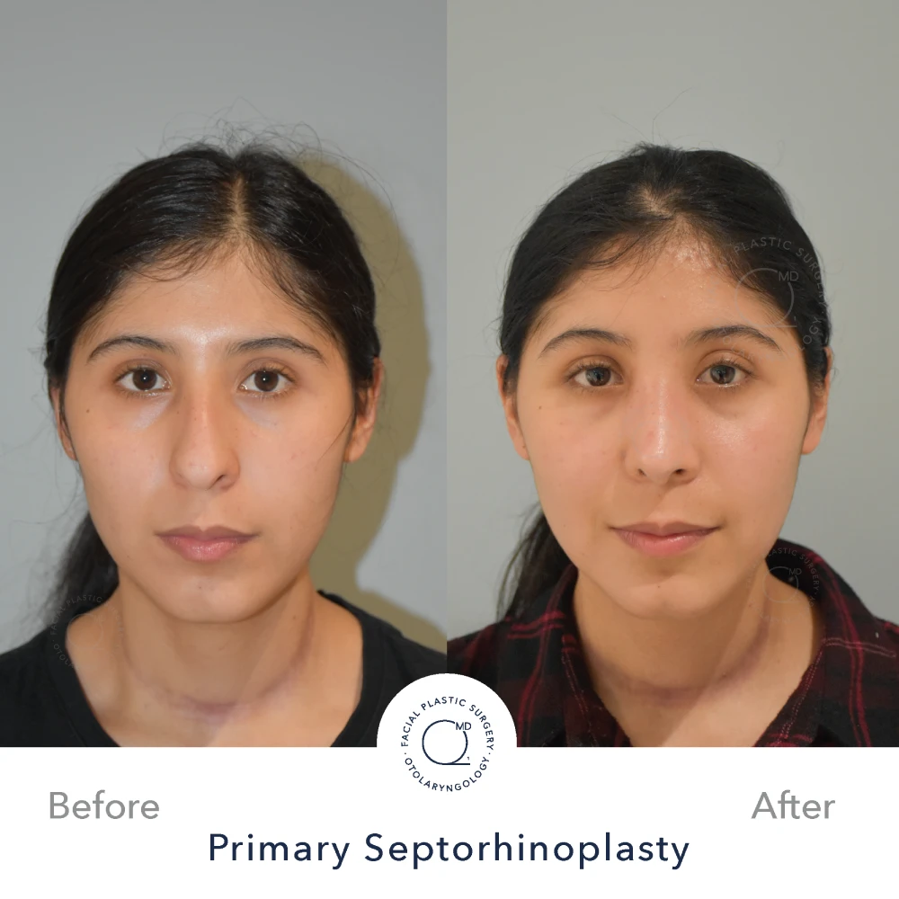 Rinoplastia Madrid caso 39 fotografía 5