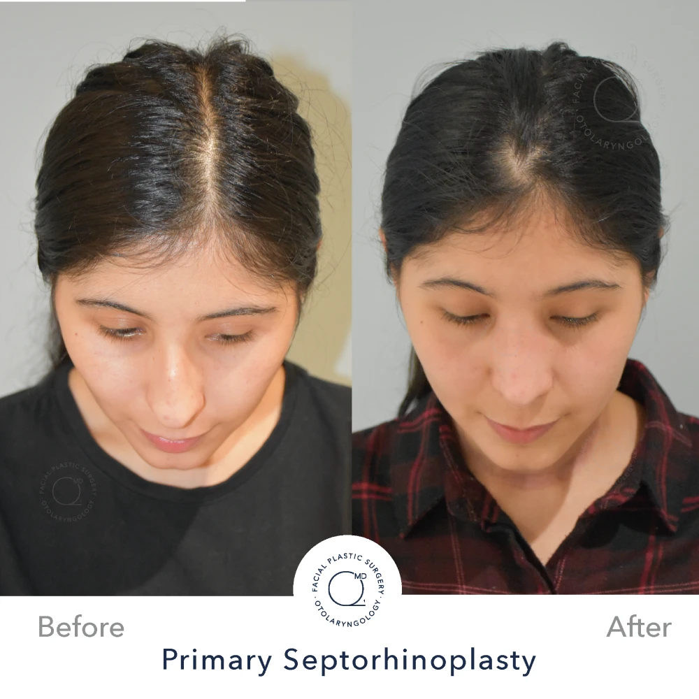 Rinoplastia Madrid caso 39 fotografía 6