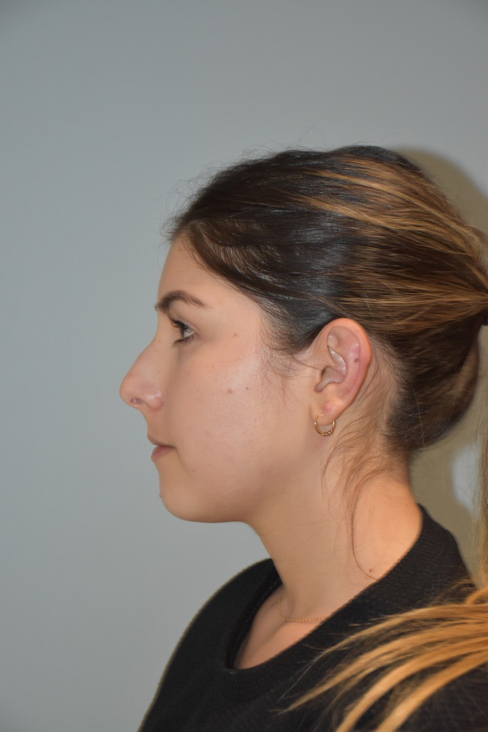 Rinoplastia Madrid caso 40 fotografía 1