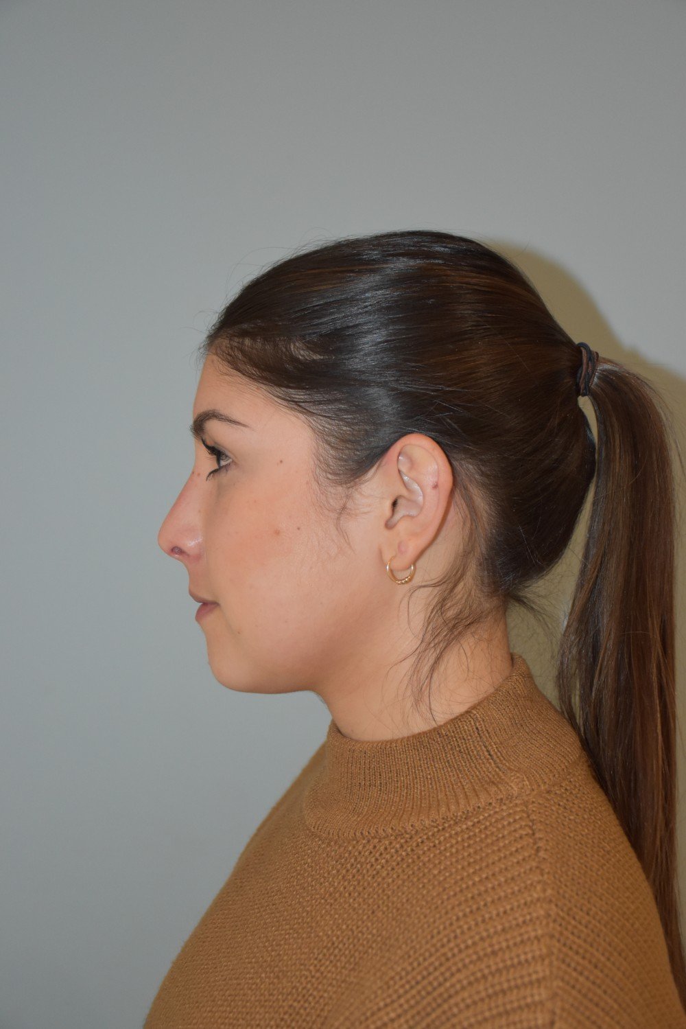 Rinoplastia Madrid caso 40 fotografía 2