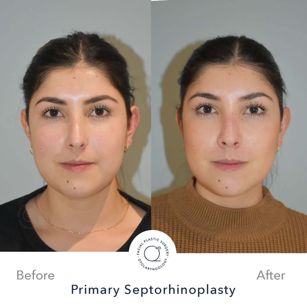 Rinoplastia Madrid caso 40 fotografía 3