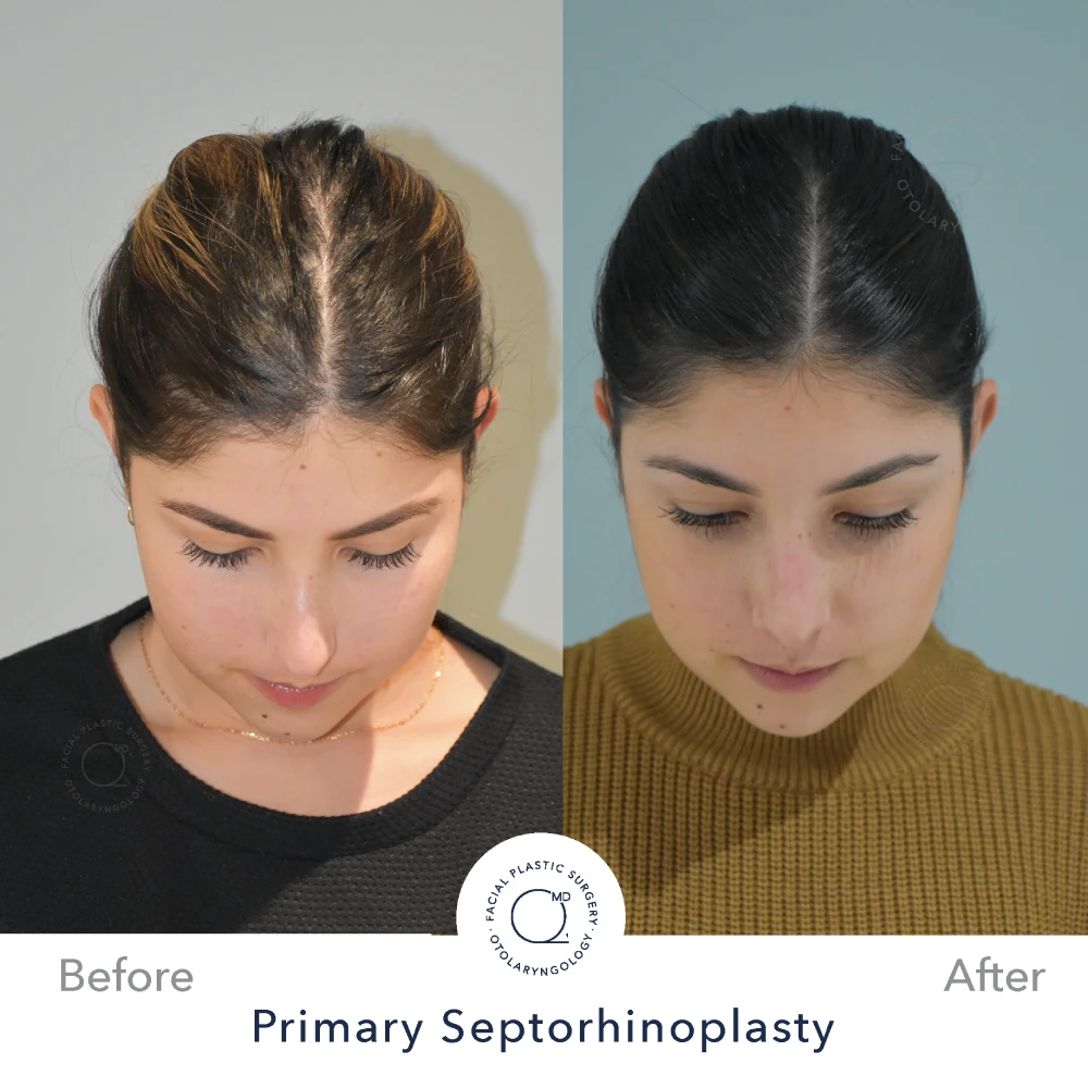 Rinoplastia Madrid caso 40 fotografía 4