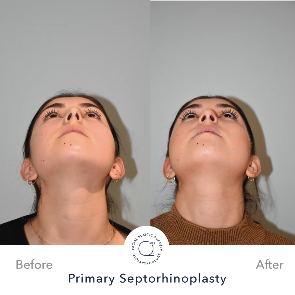 Rinoplastia Madrid caso 40 fotografía 5