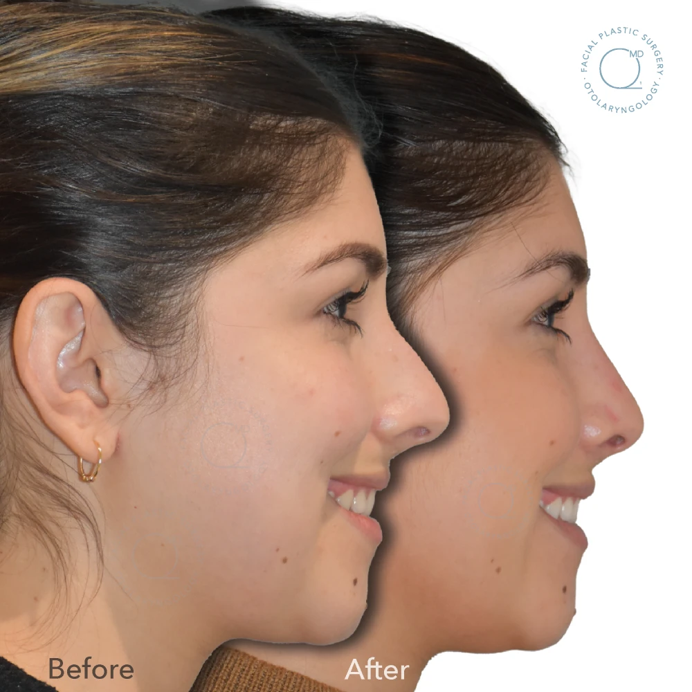 Rinoplastia Madrid caso 40 fotografía 6