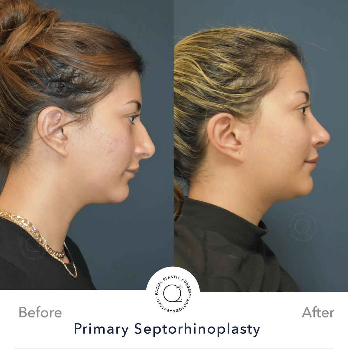 Rinoplastia femenina — fotografía 3/10