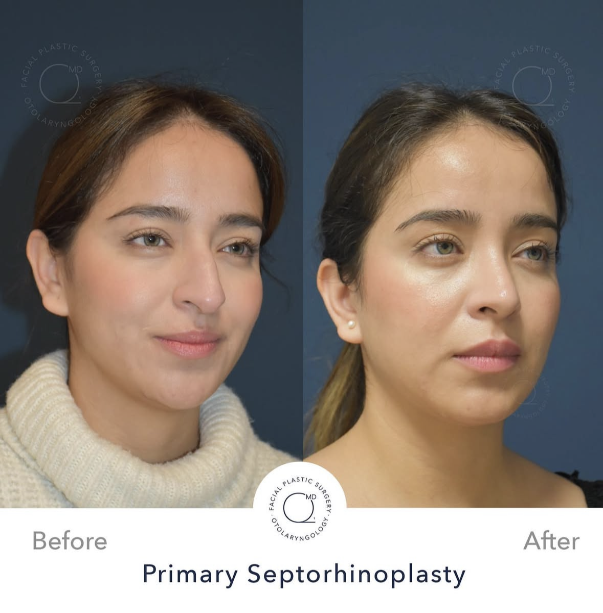 Rinoplastia femenina — fotografía interna 6