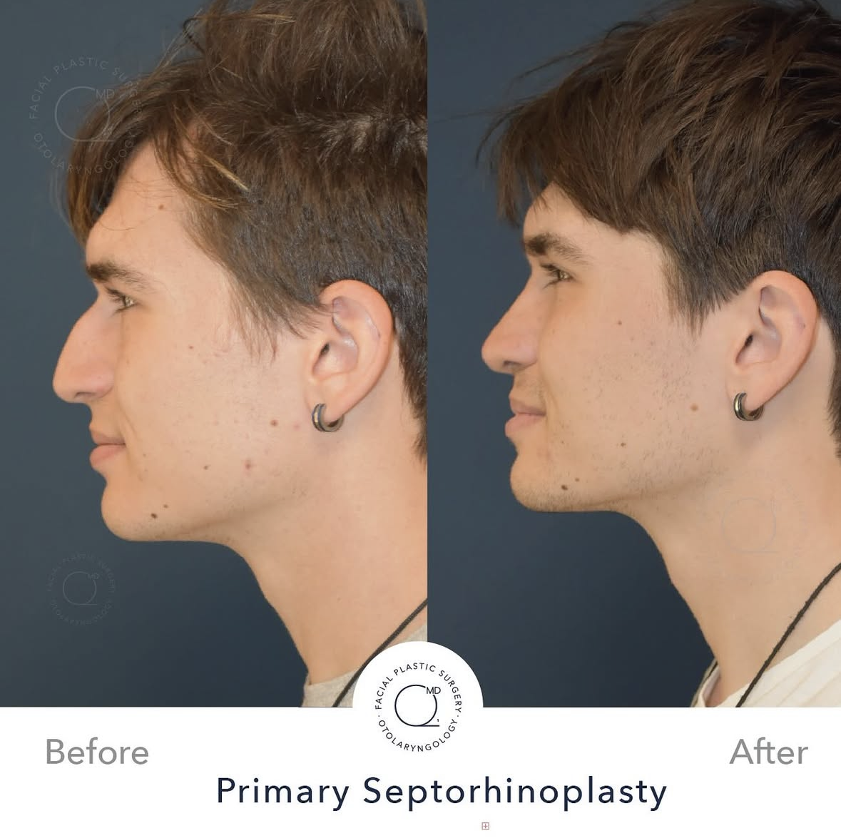 Rinoplastia masculina — fotografía interna 2