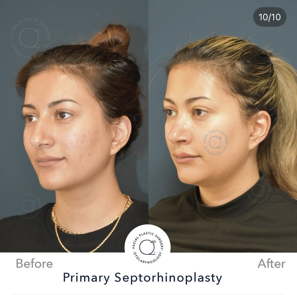 Rinoplastia femenina — fotografía 10/10