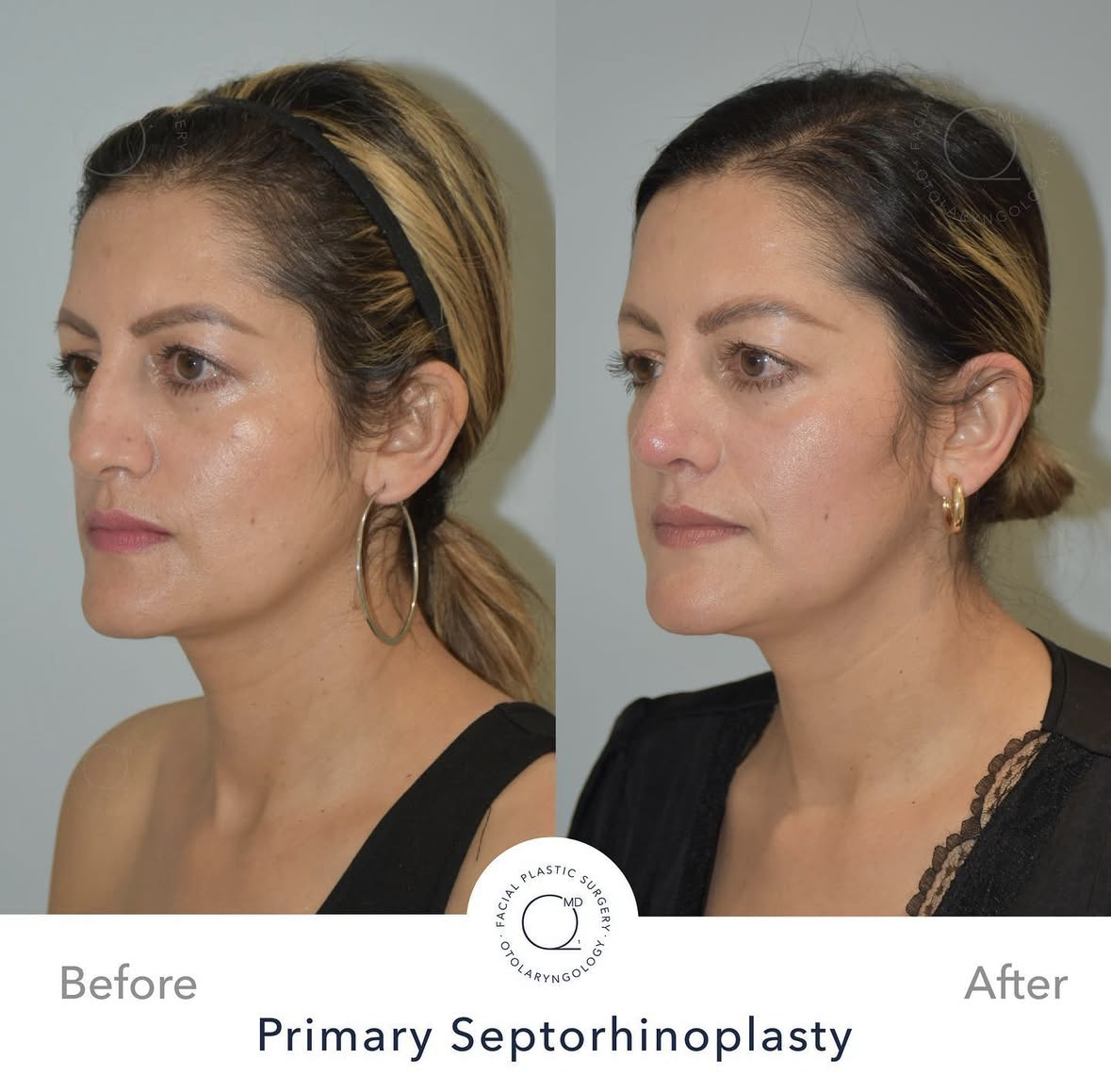 Rinoplastia Madrid caso 1 fotografía 5