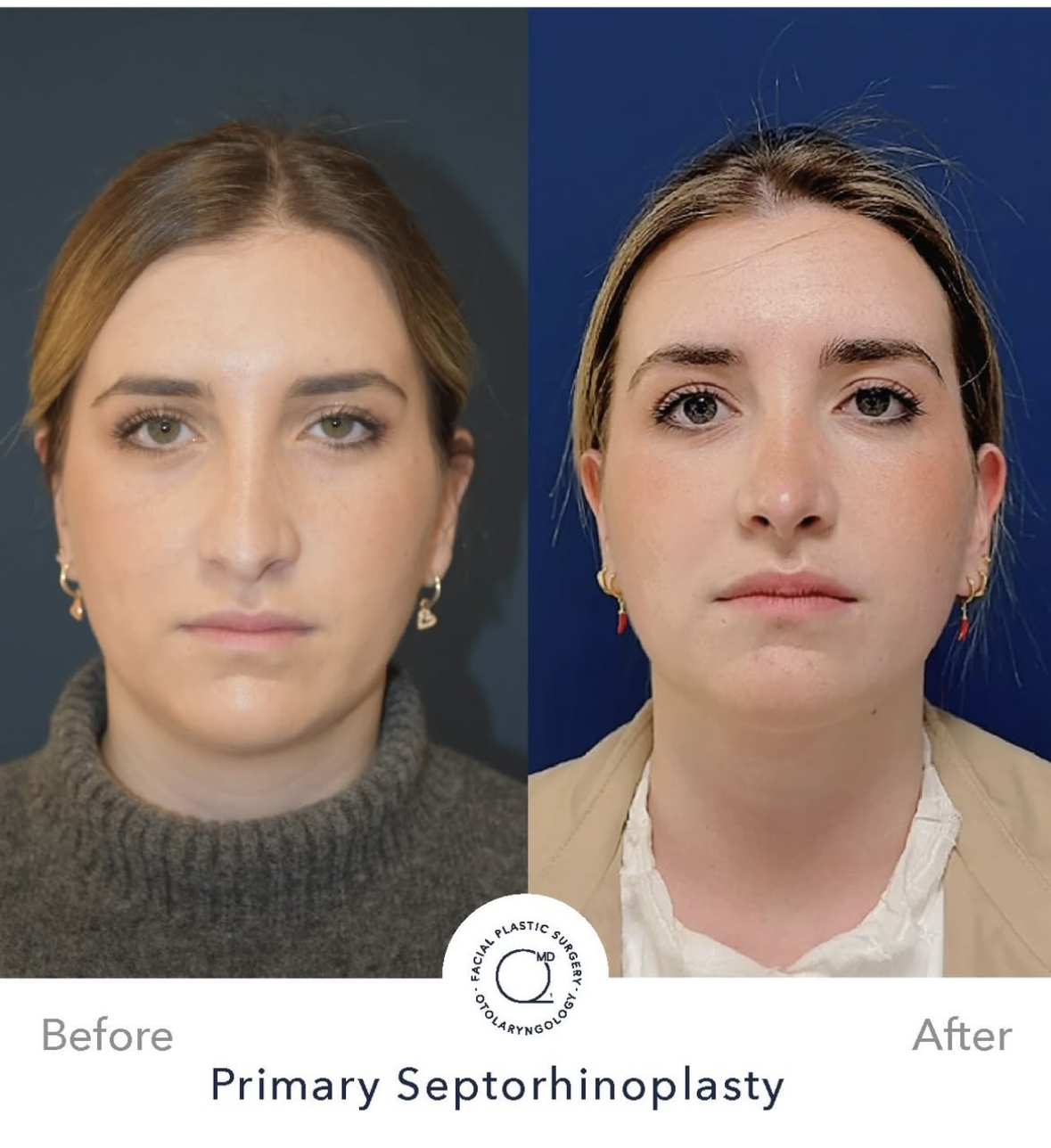 Rinoplastia femenina — fotografía interna 3