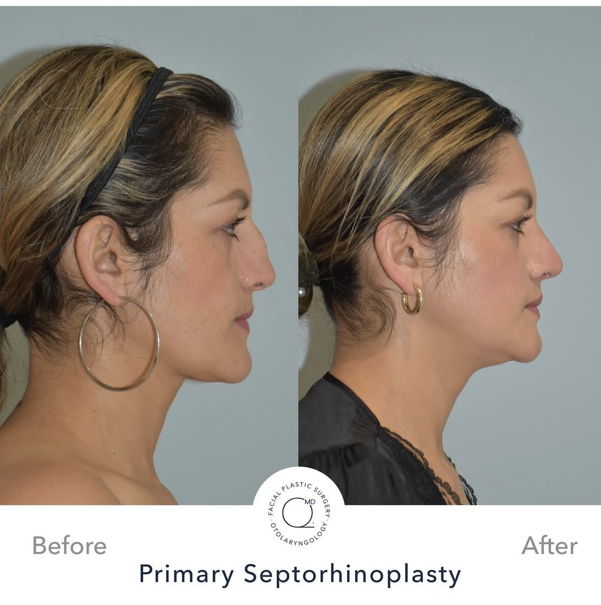 Rinoplastia Madrid caso 1 fotografía 3