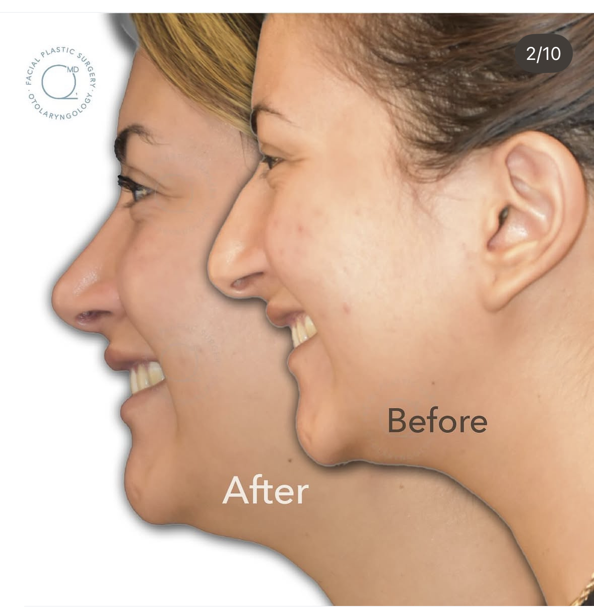 Rinoplastia femenina — fotografía 2/10