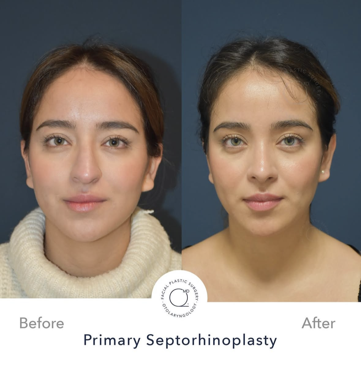 Rinoplastia femenina — fotografía interna 2